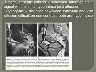 Tubercular septic arthritis – synoviam intermediate
signal with minimal hyperintnse joint effusion
Pyeogenic – distiction bewtween synovium and joint
effusion difficult on non contrast both are hyperintnse
 