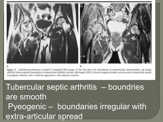 Tubercular septic arthritis – boundries
are smooth
Pyeogenic – boundaries irregular with
extra-articular spread
 