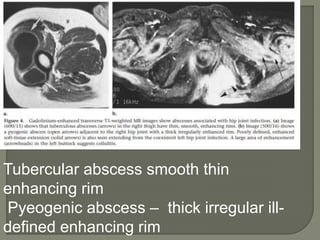 Tubercular abscess smooth thin
enhancing rim
Pyeogenic abscess – thick irregular ill-
defined enhancing rim
 