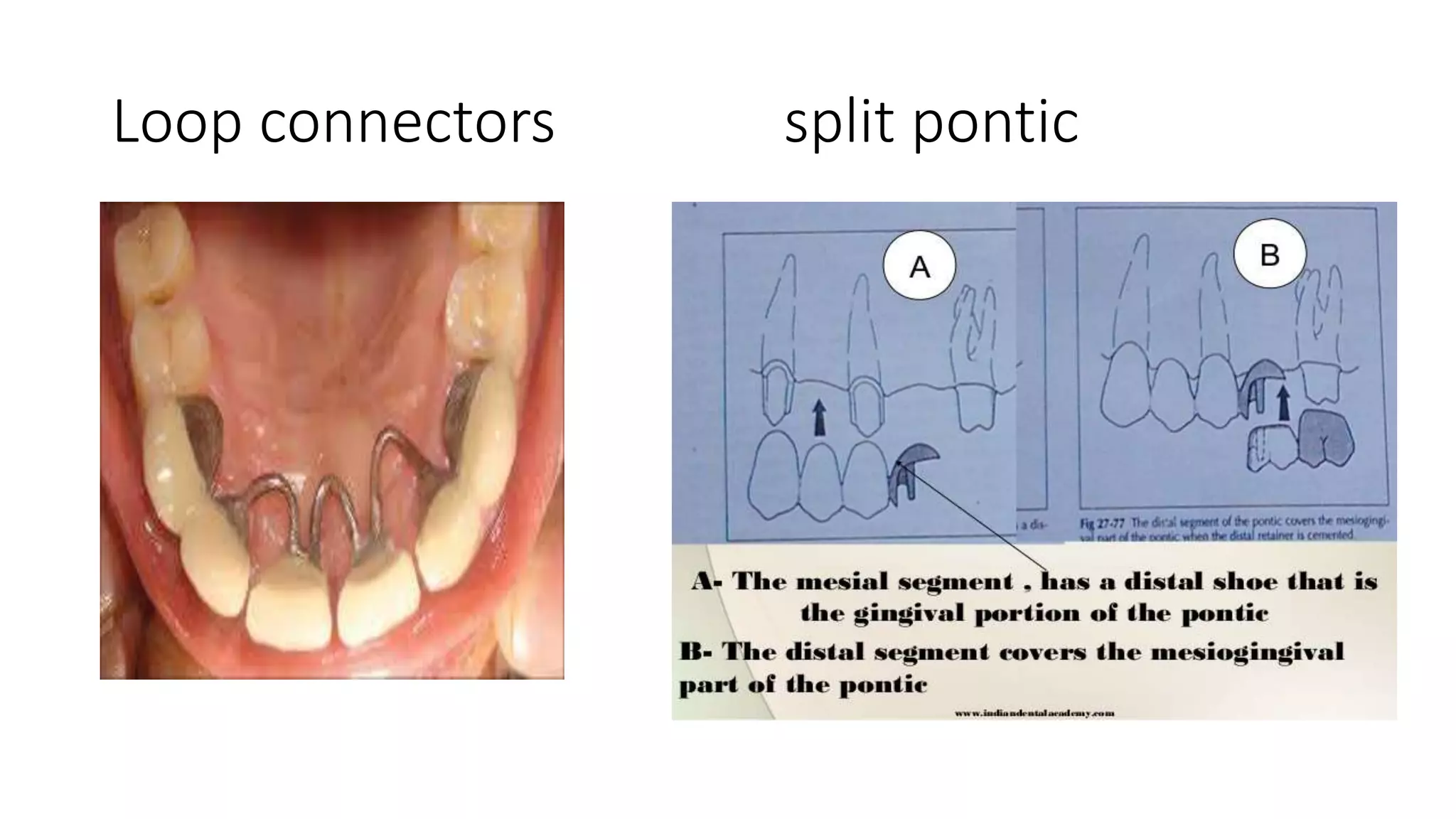different designs of dental bridges | PPTX