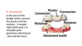 different designs of dental bridges | PPTX