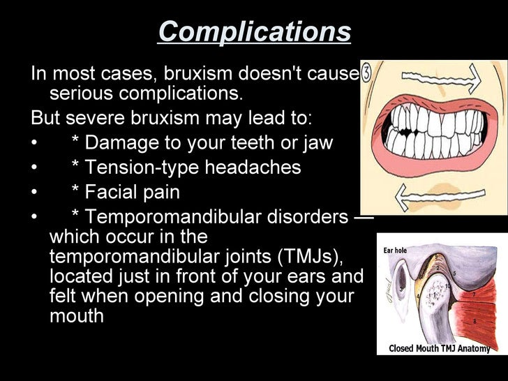 bruxism