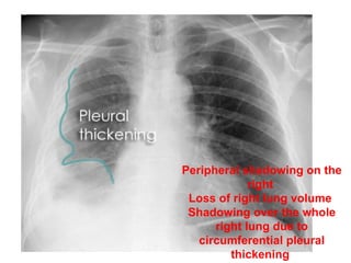 Peripheral shadowing on the right  Loss of right lung volume  Shadowing over the whole right lung due to circumferential pleural thickening  