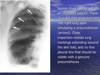 Supine chest radiograph of  an intubated patient. There is a skin fold projected over the right lung apex  simulating a pneumothorax  (arrows). Close  inspection reveals lung  markings extending beyond  the skin fold, and no fine  pleural line that should be  visible with a genuine  pneumothorax 