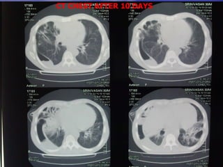 CT CHEST AFTER 10 DAYS 