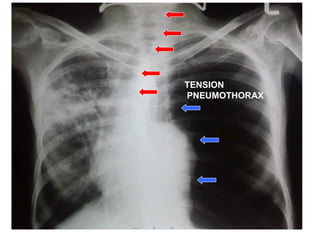 TENSION PNEUMOTHORAX 