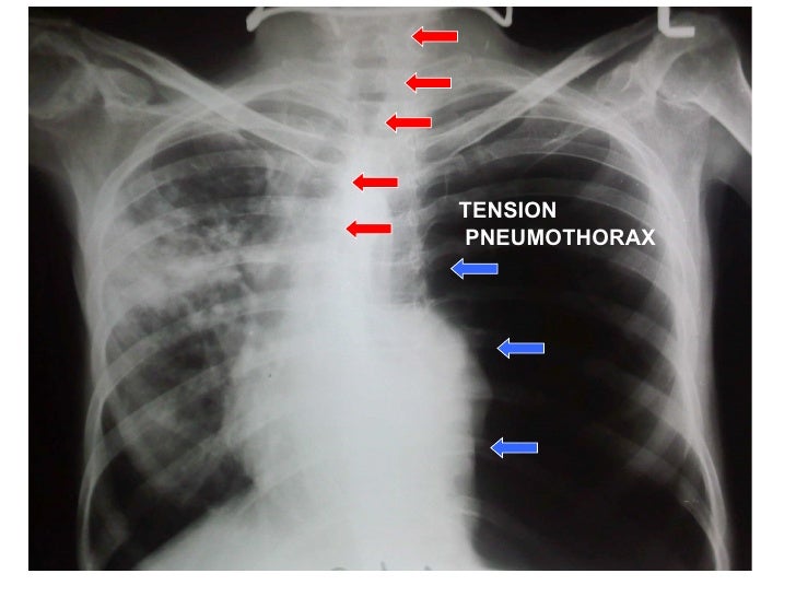 CXR: Pneumothorax / Pleural Thickening