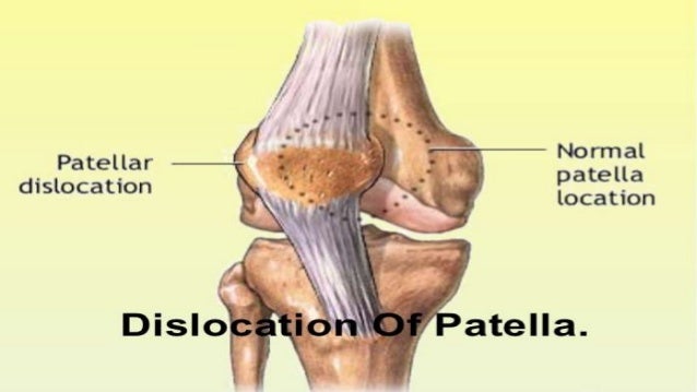 patella dislocation Patella kneecap dislocations kneecap dislocation occurs when the kneecap is moved away from the position it is supposed to be in the kneecap is held over the patellofemoral groove by tendons and ligaments, and if the knee is hit, usually by falling or banging into something, it can be knocked out of place. patella dislocation Patella kneecap dislocations kneecap dislocation occurs when the kneecap is moved away from the position it is supposed to be in the kneecap is held over the patellofemoral groove by tendons and ligaments, and if the knee is hit, usually by falling or banging into something, it can be knocked out of place.