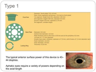 Type 1
The typical anterior surface power of this device is 43–
44 dioptres.
Aphakic eyes require a variety of powers depending on
the axial length
 