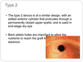Type 2
 The type 2 device is of a similar design, with an
added anterior cylinder that protrudes through a
permanently closed upper eyelid, and is used in
end-stage dry eye
 Back plates holes are important to allow the
nutrients to reach the graft keratocytes from the
aqueous
 