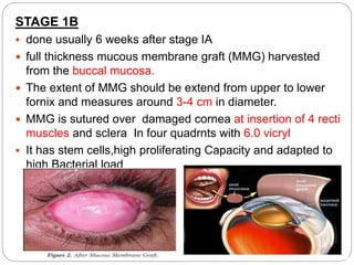 STAGE 1B
 done usually 6 weeks after stage IA
 full thickness mucous membrane graft (MMG) harvested
from the buccal mucosa.
 The extent of MMG should be extend from upper to lower
fornix and measures around 3-4 cm in diameter.
 MMG is sutured over damaged cornea at insertion of 4 recti
muscles and sclera In four quadrnts with 6.0 vicryl
 It has stem cells,high proliferating Capacity and adapted to
high Bacterial load
 