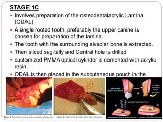 STAGE 1C
 Involves preparation of the osteodentalacrylic Lamina
(ODAL)
 A single rooted tooth, preferably the upper canine is
chosen for preparation of the lamina.
 The tooth with the surrounding alveolar bone is extracted.
 Then sliced sagitally and Central hole is drilled
 customized PMMA optical cylinder is cemented with acrylic
resin
 ODAL is then placed in the subcutaneous pouch in the
orbitozygomatic area for next 3 months to develop
vascularization and to promote the growth of connective
tissue.
 
