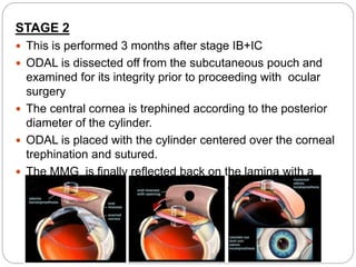 STAGE 2
 This is performed 3 months after stage IB+IC
 ODAL is dissected off from the subcutaneous pouch and
examined for its integrity prior to proceeding with ocular
surgery
 The central cornea is trephined according to the posterior
diameter of the cylinder.
 ODAL is placed with the cylinder centered over the corneal
trephination and sutured.
 The MMG is finally reflected back on the lamina with a
central trephination through which the anterior cylinder
protrudes out
 