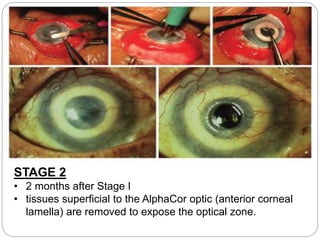 STAGE 2
• 2 months after Stage I
• tissues superﬁcial to the AlphaCor optic (anterior corneal
lamella) are removed to expose the optical zone.
 