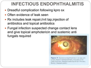 INFECTIOUS ENDOPHTHALMITIS
 Dreadful complication following kpro sx
 Often evidence of leak seen
 Rx includes leak repair,i/vit tap,injection of
antibiotics and topical antibiotics
 Fungal infection suspected change contact lens
and give topical amphotericin and systemic anti
fungals required
 