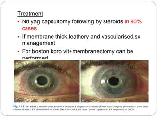 Treatment
 Nd yag capsultomy following by steroids in 90%
cases
 If membrane thick,leathery and vascularised,sx
management
 For boston kpro vit+membranectomy can be
performed
 However removal of prosthesis and repacement
with new one is preferred
 