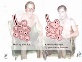 aetiology and pathogenesis of chronic obstructive lung disease | PPTX