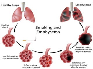 aetiology and pathogenesis of chronic obstructive lung disease | PPTX