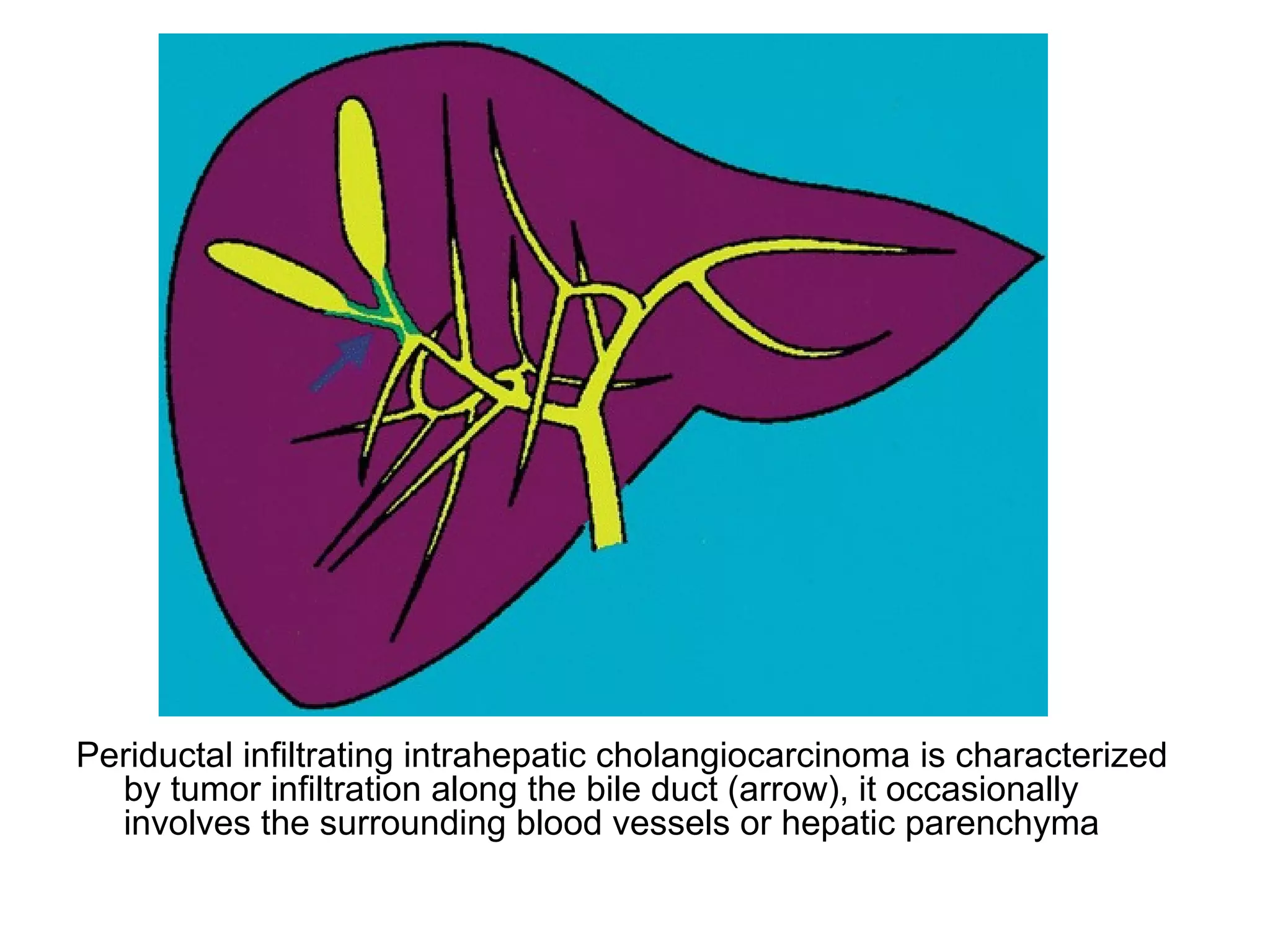 Diagnostic Imaging of Cholangiocarcinoma | PPT | Digestive Disorders ...