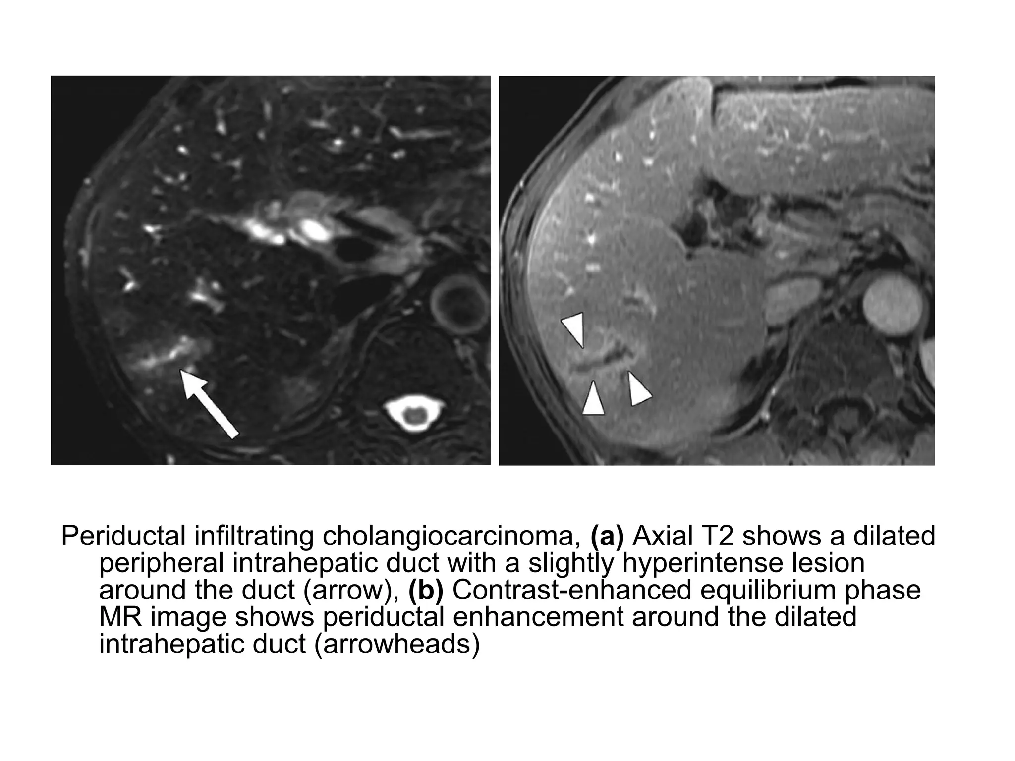 Diagnostic Imaging of Cholangiocarcinoma | PPT | Digestive Disorders ...