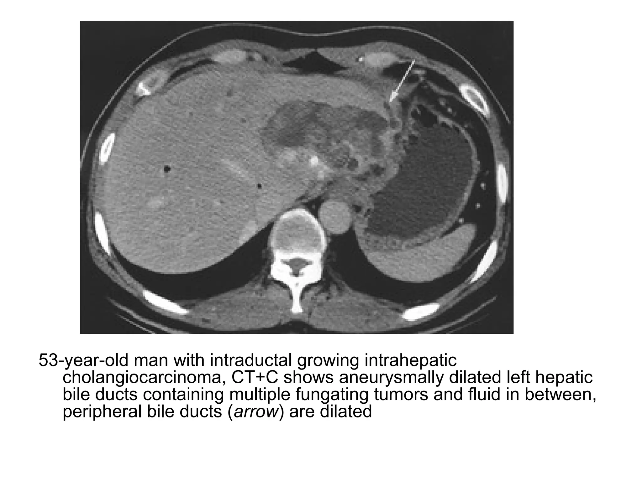 Diagnostic Imaging of Cholangiocarcinoma | PPT | Digestive Disorders ...