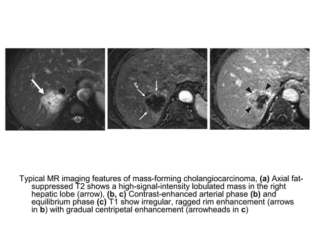 Diagnostic Imaging of Cholangiocarcinoma | PPT | Digestive Disorders ...