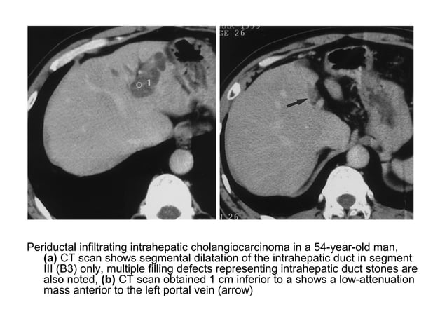 Diagnostic Imaging of Cholangiocarcinoma | PPT | Digestive Disorders ...