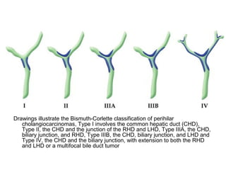 Diagnostic Imaging of Cholangiocarcinoma | PPT