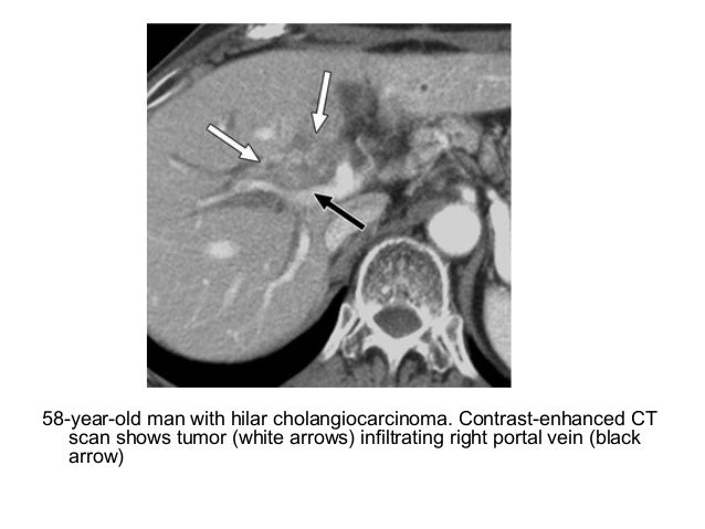 Diagnostic Imaging of Cholangiocarcinoma