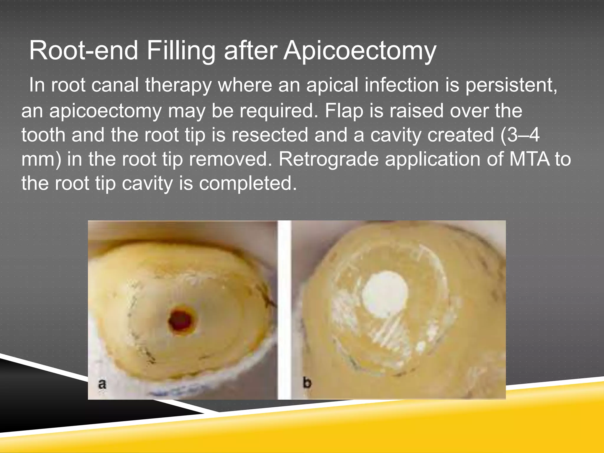 Root-end Filling after Apicoectomy
In root canal therapy where an apical infection is persistent,
an apicoectomy may be required. Flap is raised over the
tooth and the root tip is resected and a cavity created (3–4
mm) in the root tip removed. Retrograde application of MTA to
the root tip cavity is completed.
 