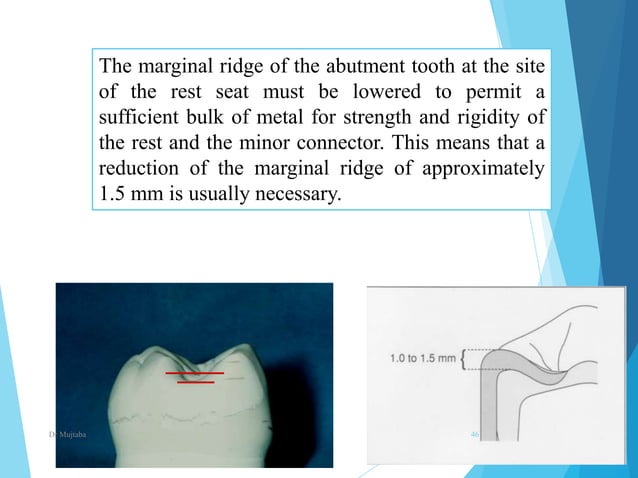 Minor connectors, rests & rests seats In prosthodontics | PPTX | Dental ...