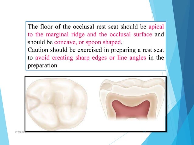 Minor connectors, rests & rests seats In prosthodontics | PPTX | Dental ...