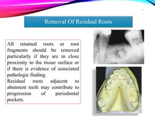 Retained Roots's Extraction Mouth preparation for Removable dental prosthesis | PPTX