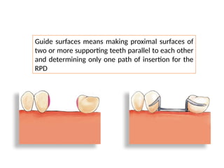 Comprehensive Guide to Mouth Preparation for Removable Partial Dentures ...
