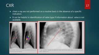 CXR
 chest x-ray are not performed on a routine basis in the absence of a specific
indication.
 It can be helpful in identification of valve type if information about valve is not
available.
17
 