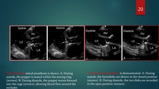 St. Jude mitral prosthesis is demonstrated. A: During
systole, the hemidisks are shown in the closed position
(arrows). B: During diastole, the two disks are recorded
in the open position (arrows).
Starr-Edwards mitral prosthesis is shown. A: During
systole, the poppet is seated within the sewing ring
(arrows). B: During diastole, the poppet moves forward
into the cage (arrows), allowing blood flow around the
occluder.
20
 