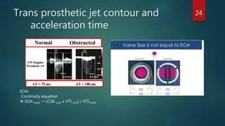 Trans prosthetic jet contour and
acceleration time
EOA-
Continuity equation
 EOA PrAV = (CSA LVO x VTI LVO) / VTI PrAV
24
 
