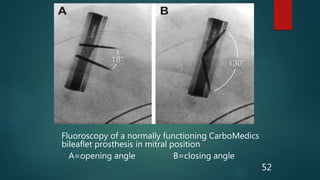 Fluoroscopy of a normally functioning CarboMedics
bileaflet prosthesis in mitral position
A=opening angle B=closing angle
52
 