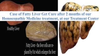 Fatty Liver and Homoeopathy Medicine Treatment