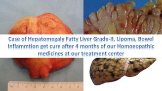 Hepatomegaly Fatty Liver Grade-II, Lipoma, Bowel Inflammtion & Homoeopathy