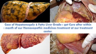 Fatty Liver, Hepatomegaly & Homoeopathy