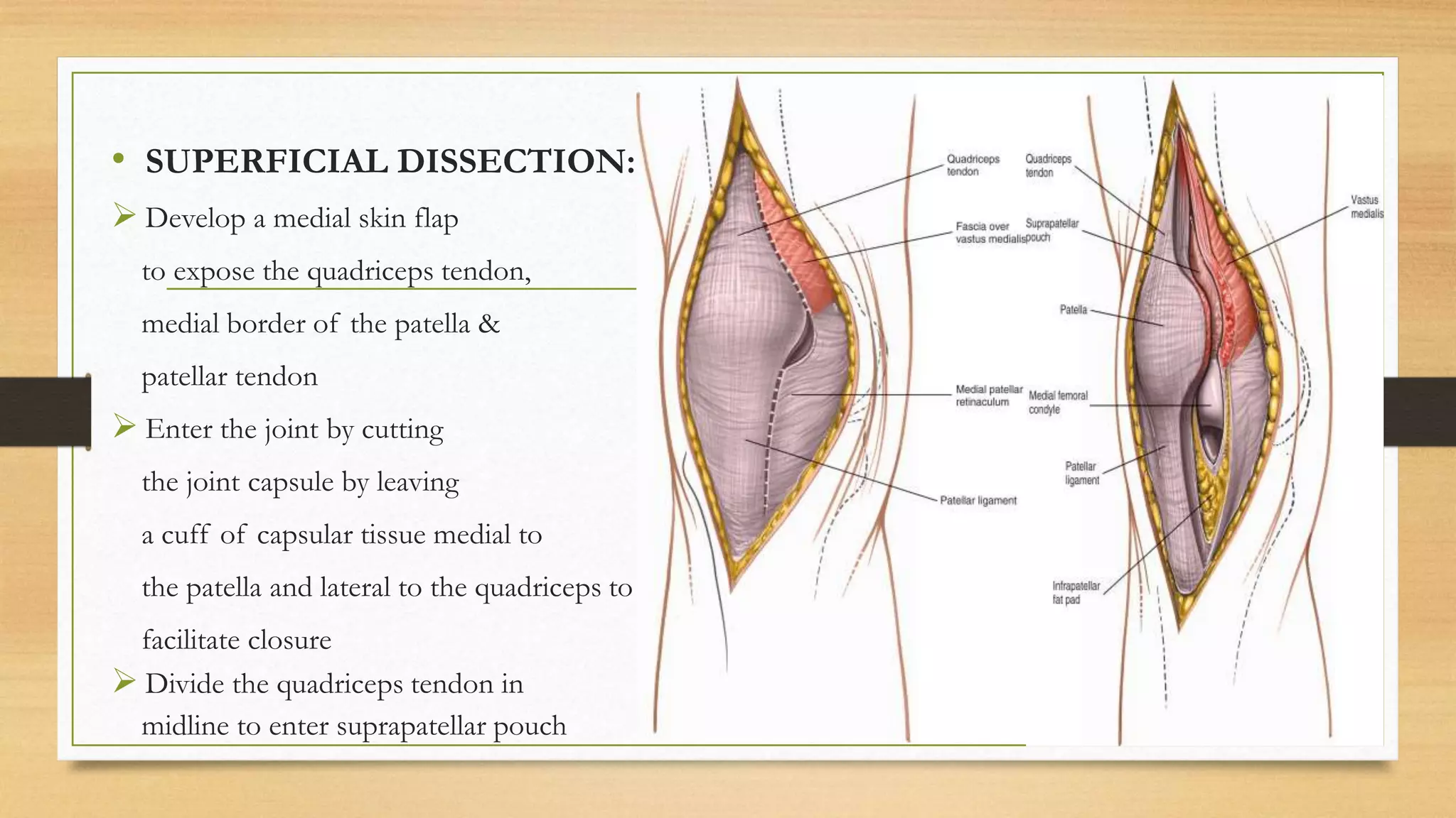 SURGICAL APPROACHES TO KNEE JOINT | PPTX