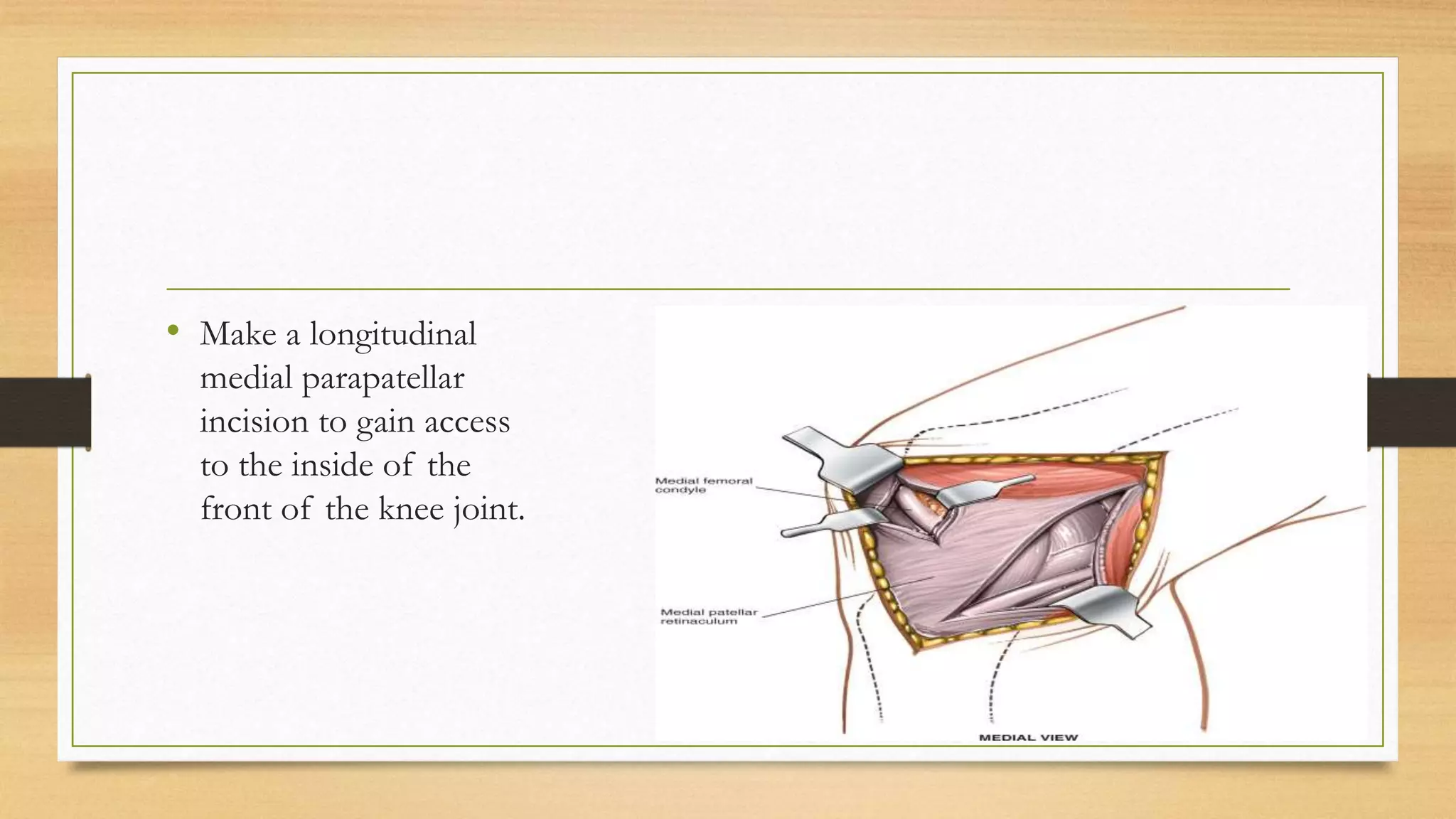 SURGICAL APPROACHES TO KNEE JOINT | PPTX