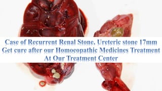 Renal stone, Hydronephrosis, Ureteric stone 17mm & Homoeopathy