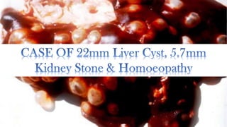 Liver Cyst 22mm, Kidney Stone 5.7mm & Homoeopathy