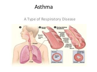 Asthma
A Type of Respiratory Disease
 