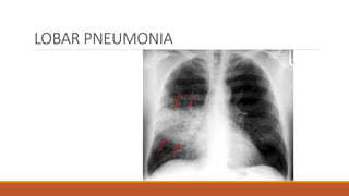 LOBAR PNEUMONIA
 