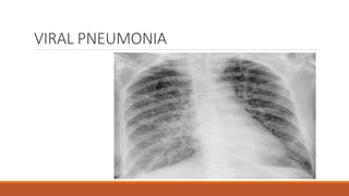 VIRAL PNEUMONIA
 
