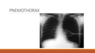 PNEMOTHORAX
 