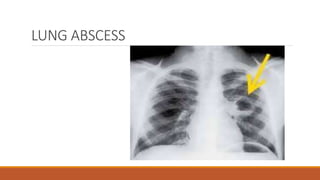 LUNG ABSCESS
 